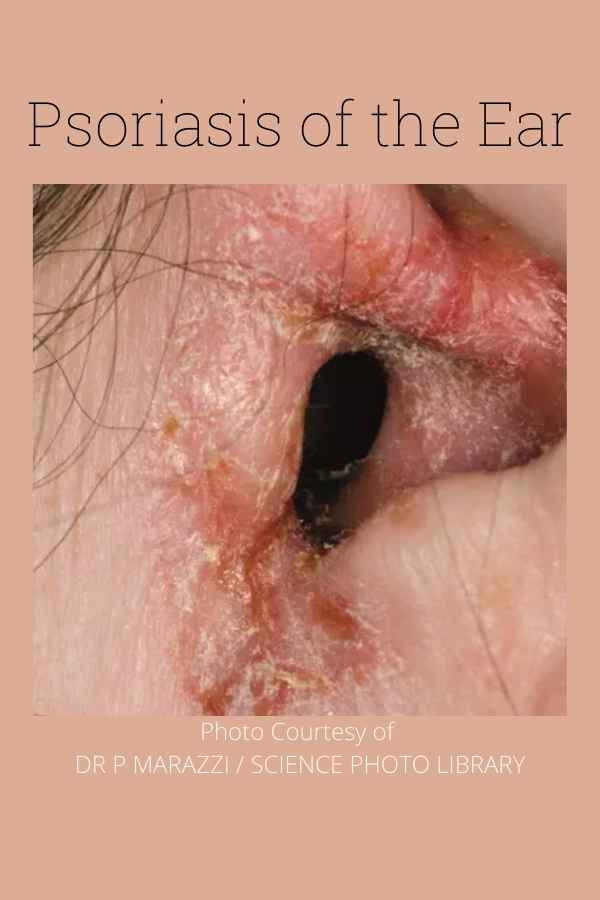 crusty ear canal