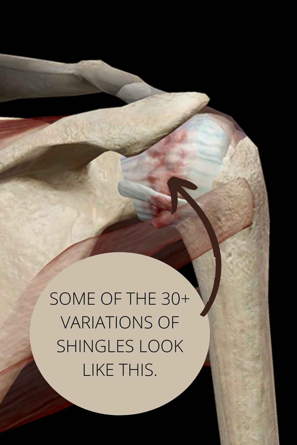 infraspinatus pain