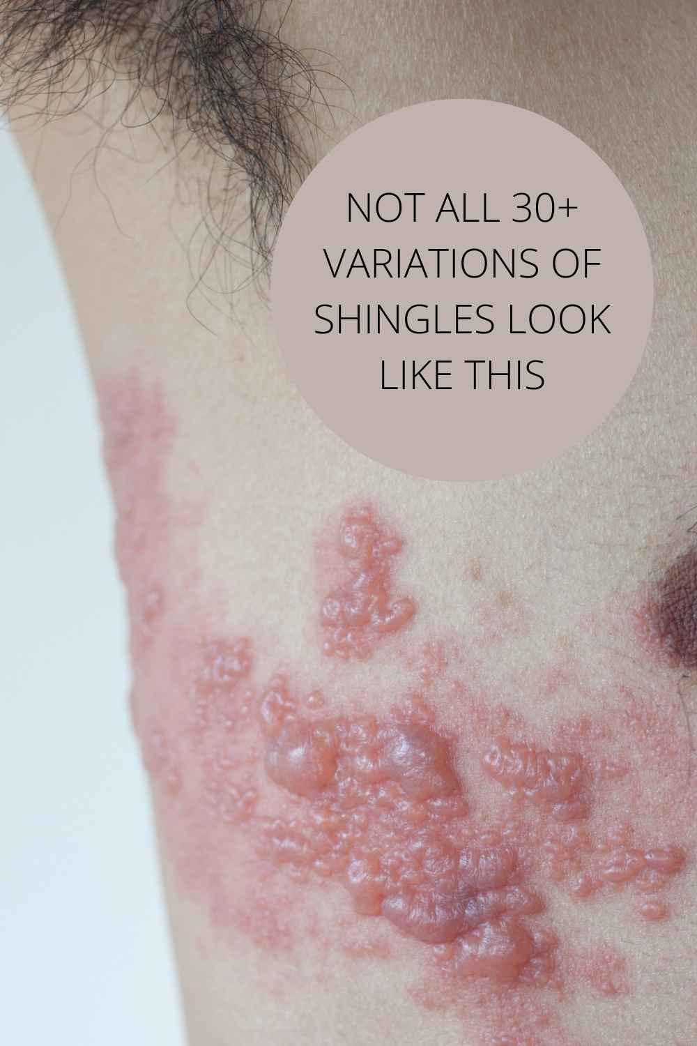 infraspinatus pain